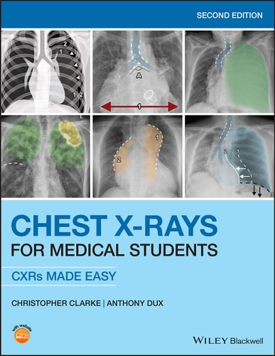 Chest X-Rays for Medical Students (2nd Edition)