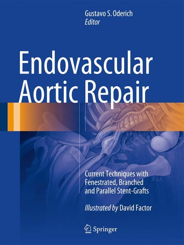 Endovascular Aortic Repair Current Techniques with Fenestrated, Branched and Parallel Stent-Grafts (1st Edition)