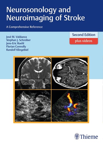 Neurosonology and Neuroimaging of Stroke (A Comprehensive Reference) (2nd Edition)