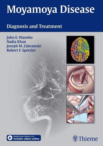 Moyamoya Disease (Diagnosis and Treatment)